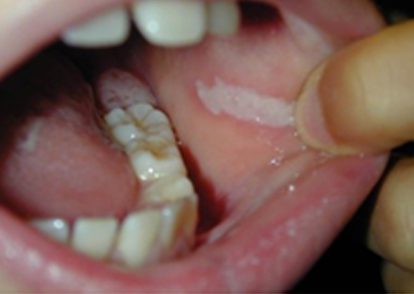 image showing what happens inside a childs mouth wen they are lip biting