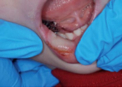 image showing what happens in a childs lip when they are lip biting